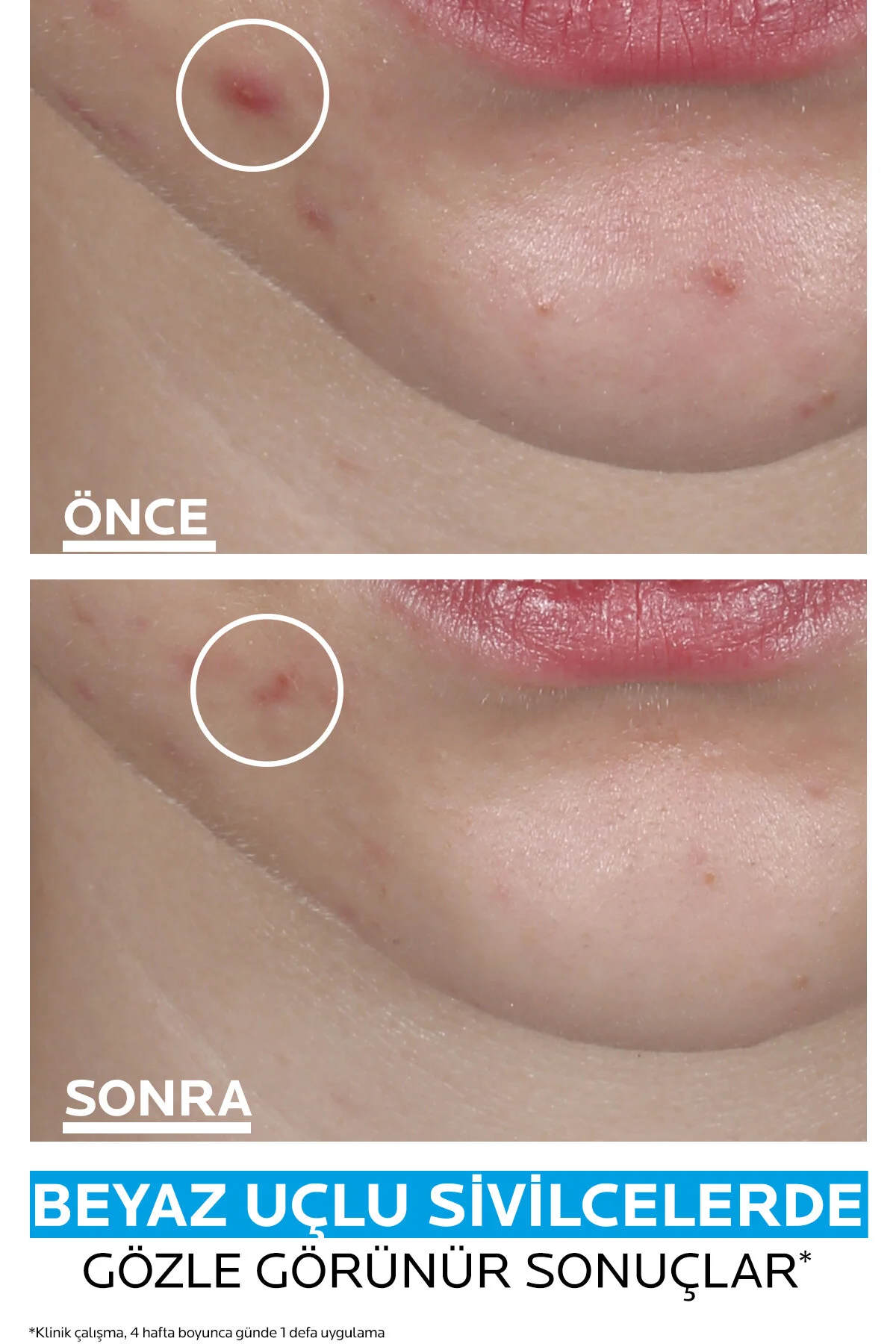 چسب جوش سرسیاه EFFACLAR DUO+M PATCH ACNE BAND La Roche Posay